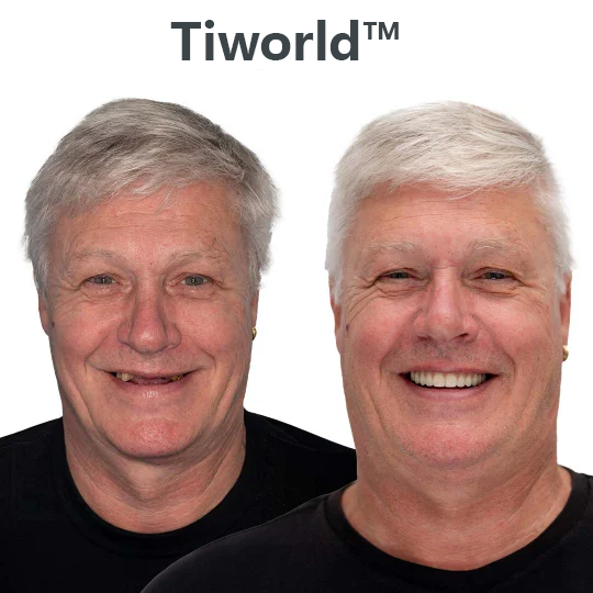 👵Health America Subsidized Product |Tiworld™ AdaptableFit Functional Dentures – Made in the USA & FDA-Certified
